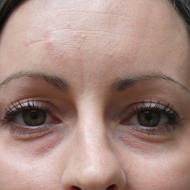 Brow lift before, close-up view