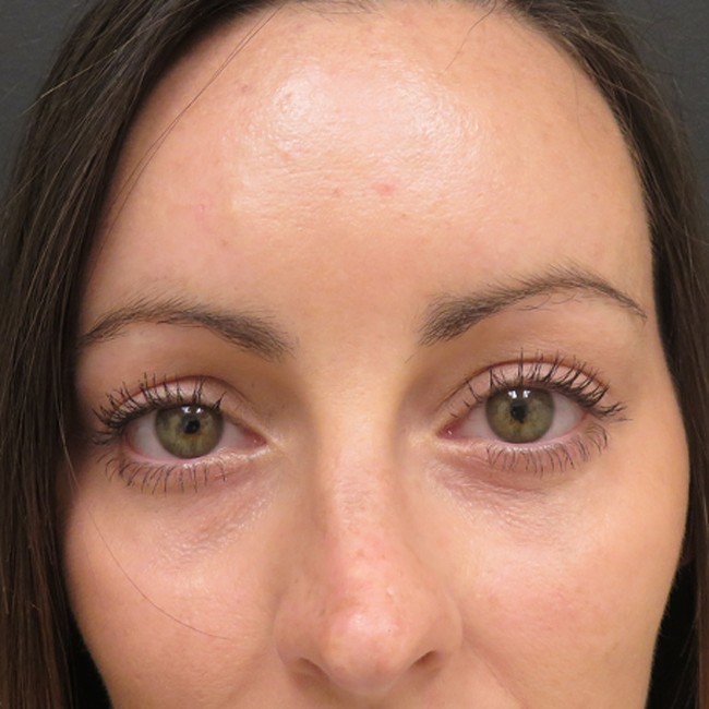 Brow lift after, close-up view