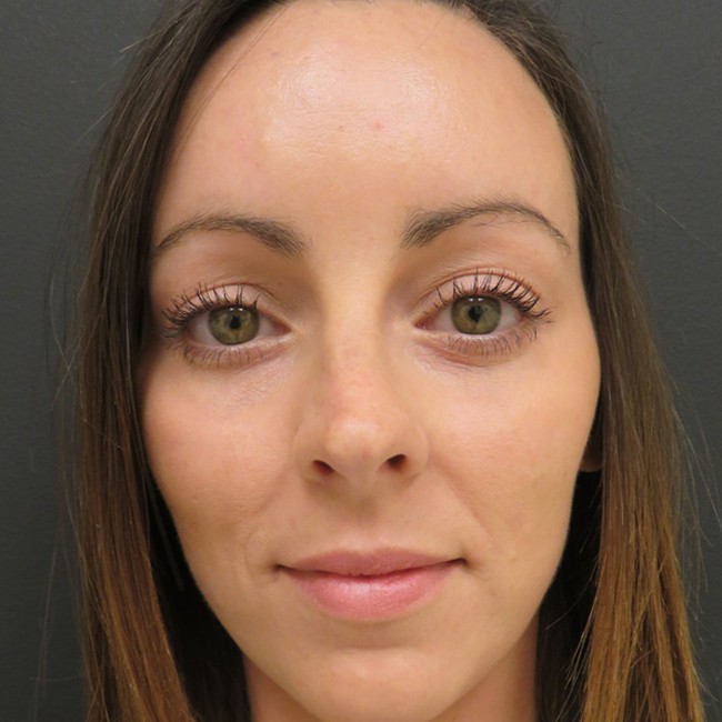 Brow lift after, front view