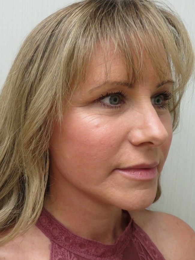 Facelift after, three-quarter view