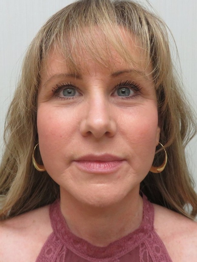 Facelift after, front view
