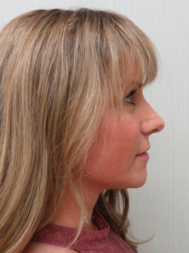 Facelift after, profile view