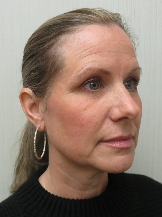 Facelift before, three-quarter view
