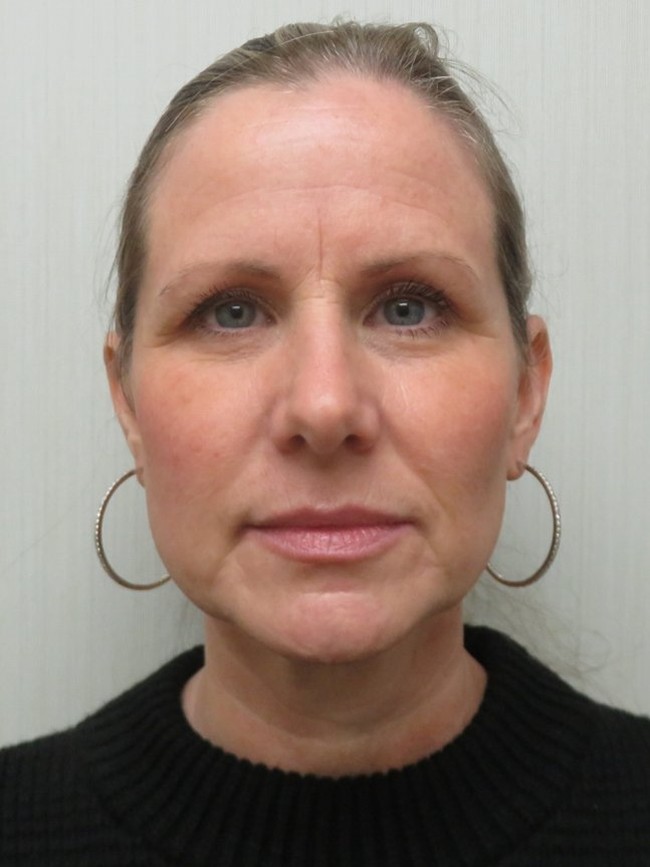 Facelift before, front view