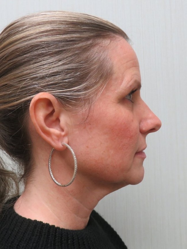 Facelift before, profile view