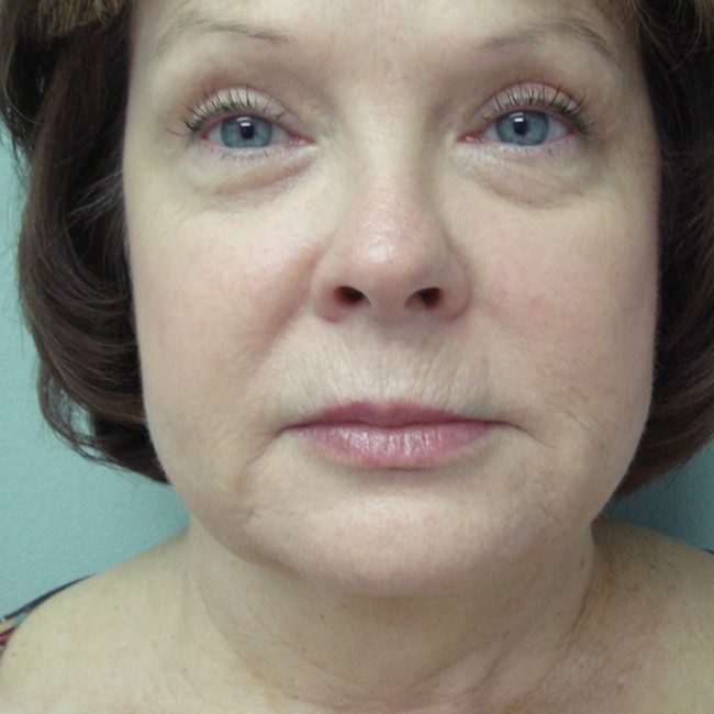 Neck lift before, front view