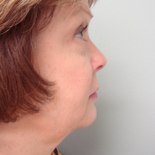 Neck lift before, profile view