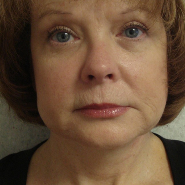 Neck lift after, front view