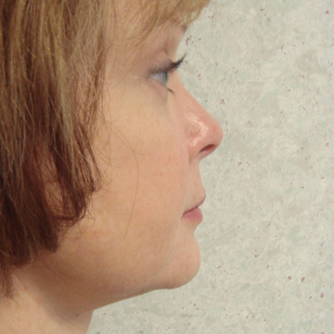 Neck lift after, profile view