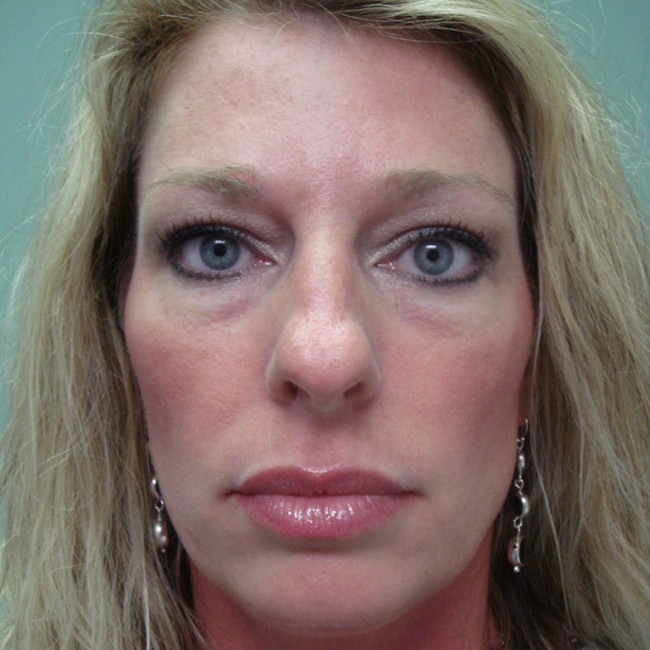 Rhinoplasty before, front view