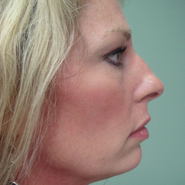 Rhinoplasty before, profile view