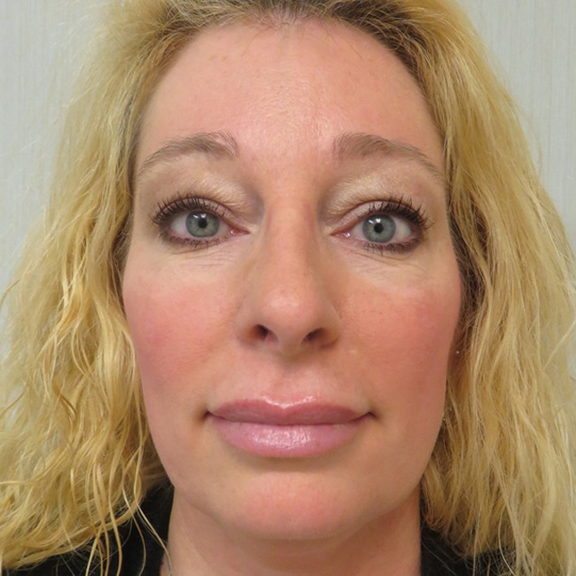 Rhinoplasty after, front view