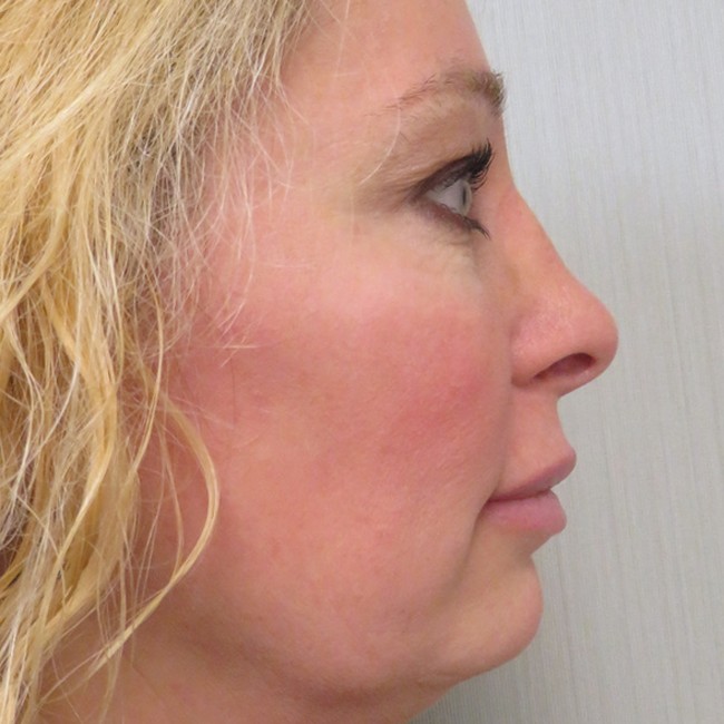 Rhinoplasty after, profile view